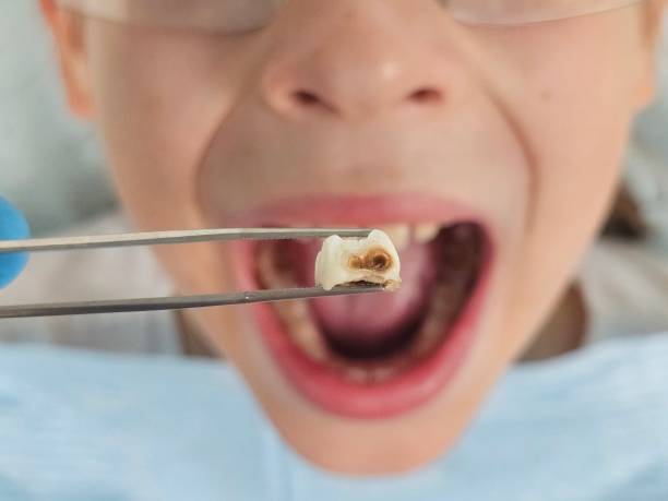 Best Emergency Wisdom Teeth Removal in Millen, GA